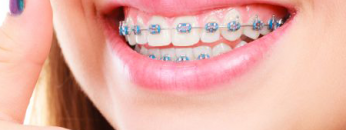 braces