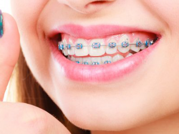 braces