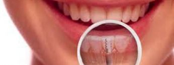 oral-sores-min