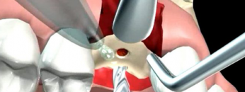 implant