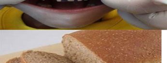 rotten-teeth