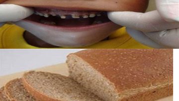 rotten-teeth