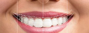 digital-smile