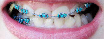 braces1