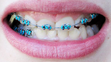 braces1