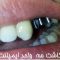 فیلم کاشت 3 واحد ایمپلنت دندان در کلینیک دندانپزشکی