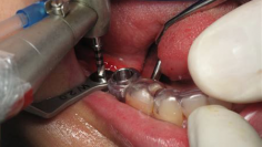 implantt