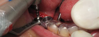 implantt