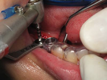 implantt