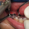فیلم چگونگی کاشت ایمپلنت دندان با برش لثه