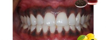 black-Gums-treatment-min