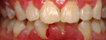 gum