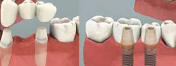implant-and-bridge1