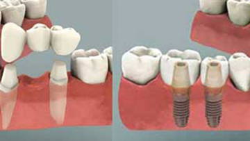 implant-and-bridge1
