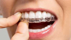 invisalign1