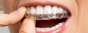 invisalign1