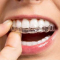 فیلم ارتودنسی شفاف دندان و توضیحاتی در باره آن
