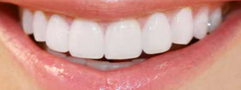 porcelain-veneers1