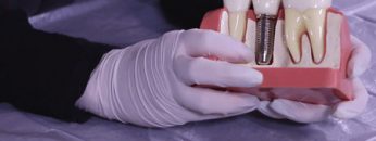 Abutment-dental-min
