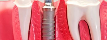 Dental-implant-with-stem-cells