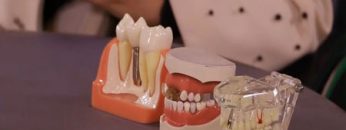 Preventing-tooth-caries2-1