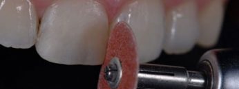 buildup-composite-min