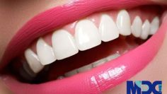 composite-veneer-min