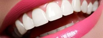 composite-veneer-min