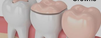 onlays-vs-inlays-dental-crowns-min