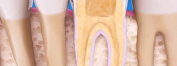 root-canal-min