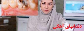 دندان-آهکی