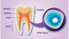 کاشت دندان با سلول های بنیادی