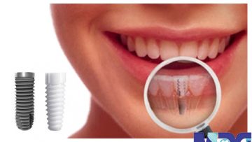 implant-pros