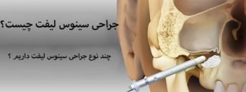 sinus-lift