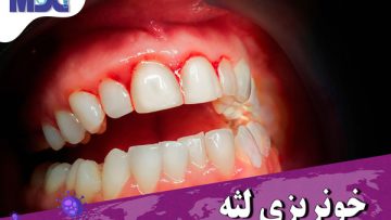 درمان بیماری لثه