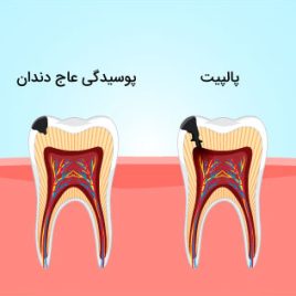 پوسیدگی-دندان