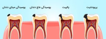 پوسیدگی-دندان
