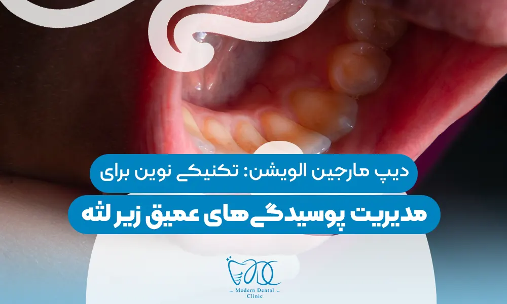 تصویر پیش بار گذاری