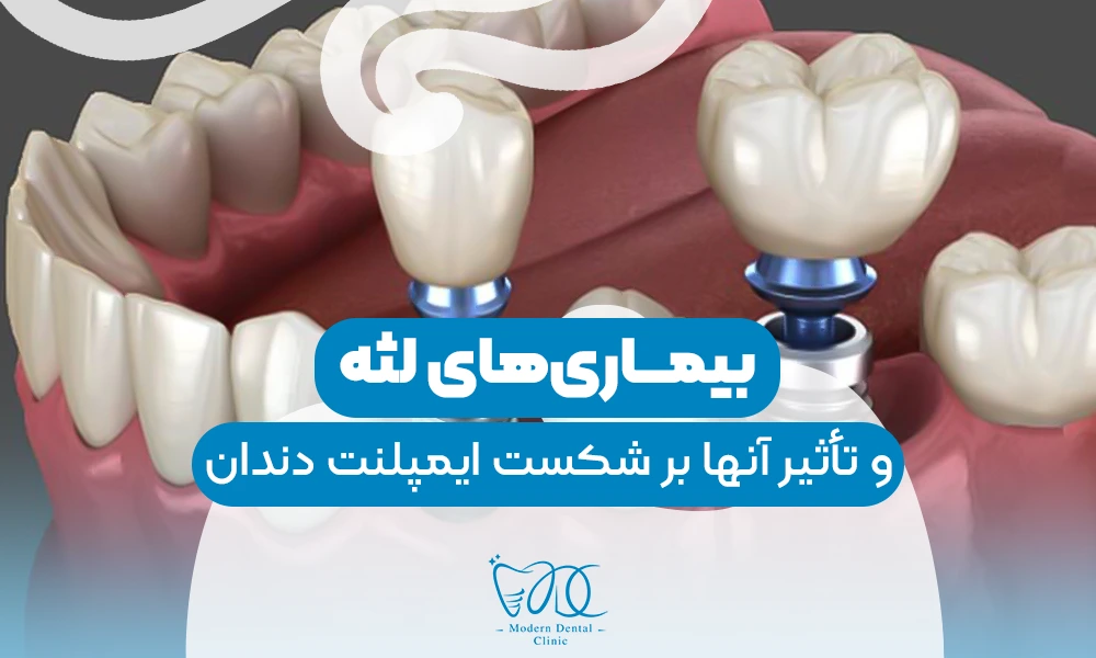 تصویر پیش بار گذاری