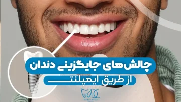 challenges-of-tooth-replacement-via-implants 1