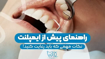 pre-dental-implant-guide 1