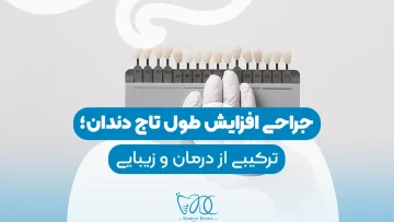 Dental crown lengthening surgery-11