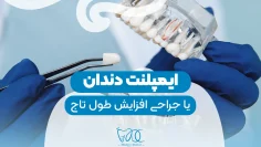 Implants or crown lengthening surgery-1