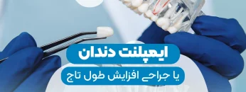 Implants or crown lengthening surgery-1